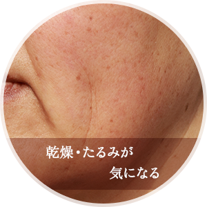 乾燥・たるみが気になる